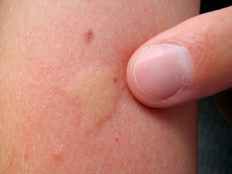 O reacție alergică la mușcătura de țânțar - umflături și roșeață a pielii