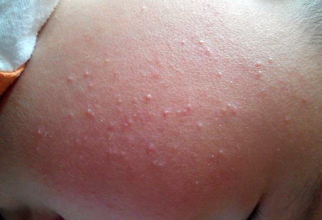 Allergy to parasites in a child