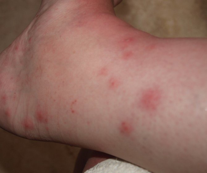 алергия към прахови акари