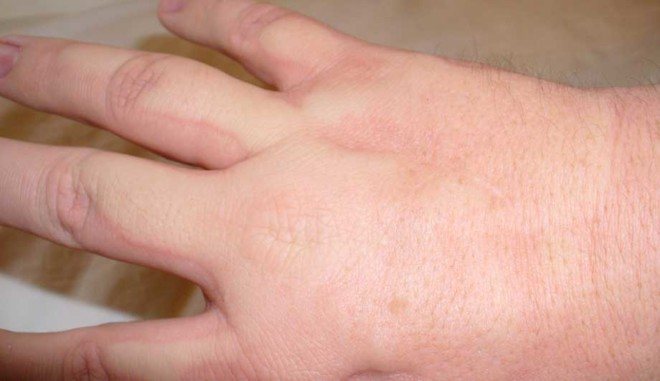 Алергия към ухапване от бълхи