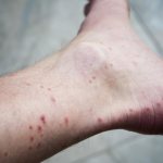Alergie na kousnutí blechami