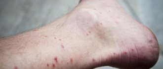 Flea bite allergy