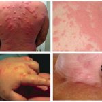 Алергия към ухапвания от бъгове