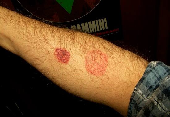 Allergy to bedbug bites: photo