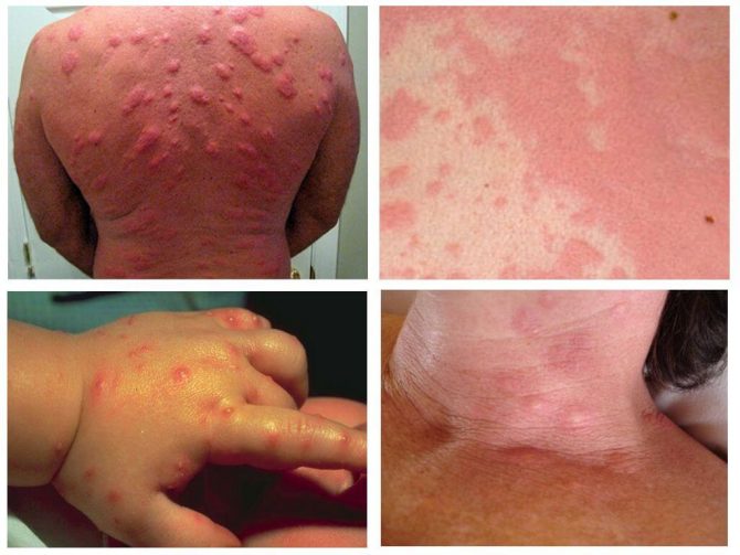 Алергия към ухапвания от бъгове