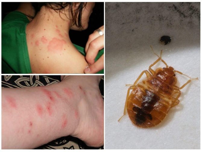 Алергия към ухапвания от насекоми