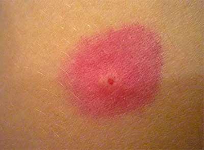 Алергия към ухапване от бълхи при хората