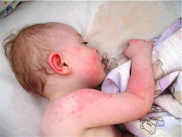 Алергия при дете от ухапвания от дървеници