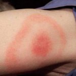 Mga sintomas at paggamot sa sakit na Lyme