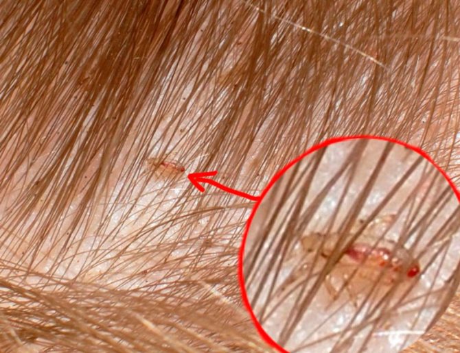 De vanligaste mänskliga lössen infekterar hårbotten.