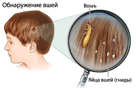Dichlorvos from lice and nits is it possible to remove, reviews and how to poison