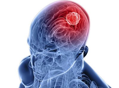 Encephalitis: otak, penyebab, gejala, diagnosis, rawatan dan pencegahan yang disebabkan oleh kutu