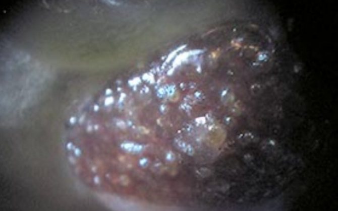 снимка -3 далак на риба с туберкулоза, виждат се туберкули (грануломи, възли, съдържащи микроорганизъм).