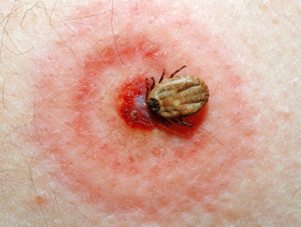 The characteristic red border in several rings around the bite site is one of the clear signs of tick-borne borreliosis.