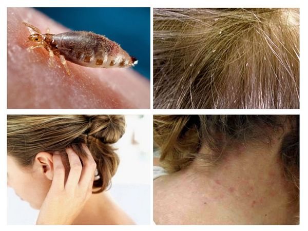 Chronic head lice