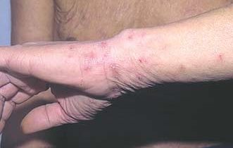 How long does itchiness last after scabies treatment?