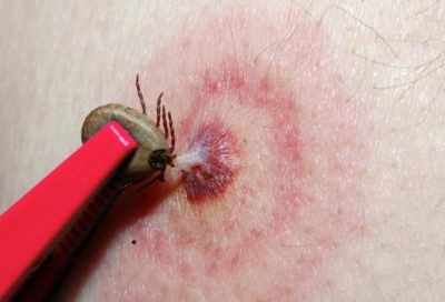 How to distinguish an encephalitis tick from a common one 3