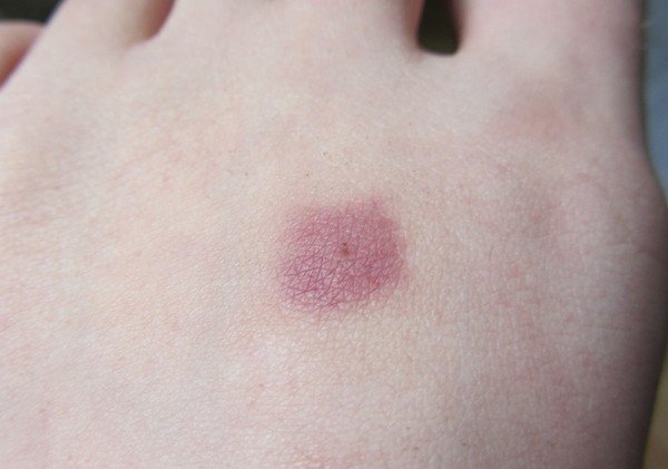 What does a tick bite look like?