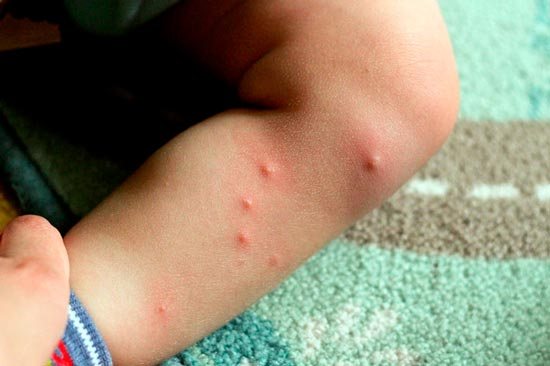 What do bedbug bites look like in children: photo