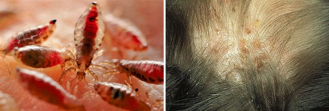 What natural oils are best for getting rid of lice and nits
