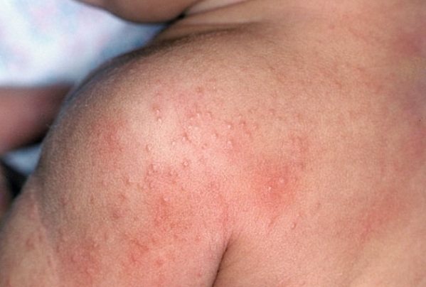 Anong mga parasito ang sanhi ng mga allergy sa mukha