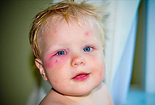 Kousnutí komárem u oka dítěte