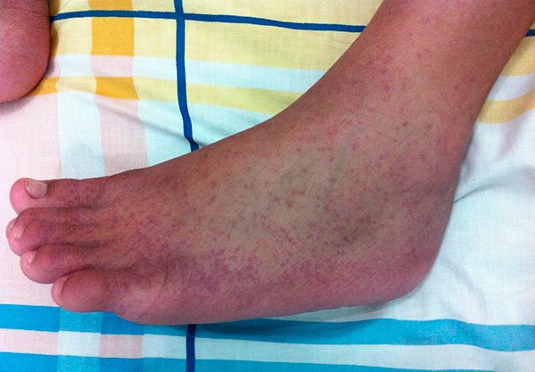 Hemorrhages of the skin from hemorrhagic fever