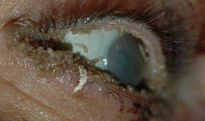 دودة مستديرة في عيون الإنسان