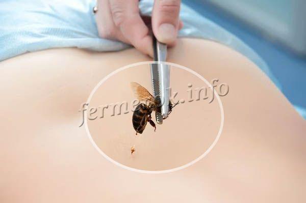يسمى علاج سم النحل بعلاج النحل.