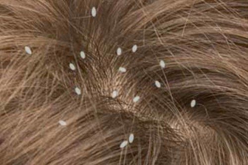 How to distinguish dead nits from living ones