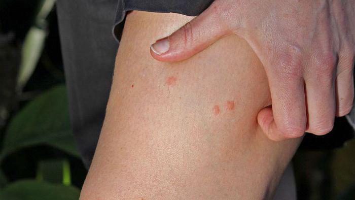 Опасността от ухапване на мушици за хората: снимка