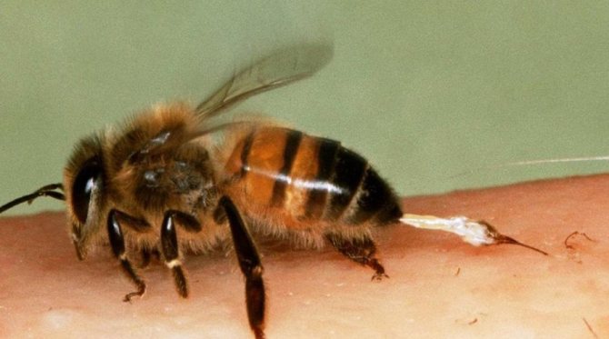 Empoisonnement au venin d'abeille