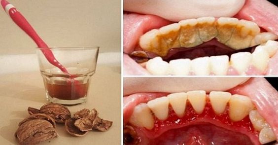 Avkok av valnötskal kan användas för att ta bort tandsten.