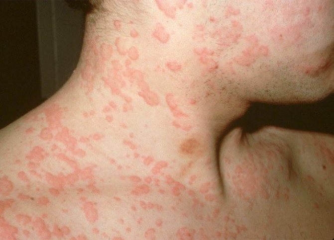 Parasites that can cause skin allergies