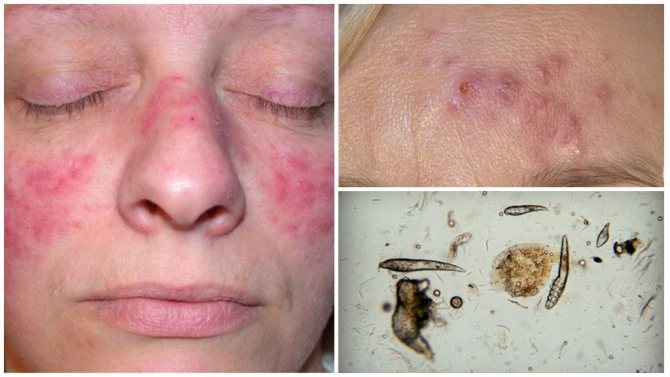 Subcutaneous mite on the face