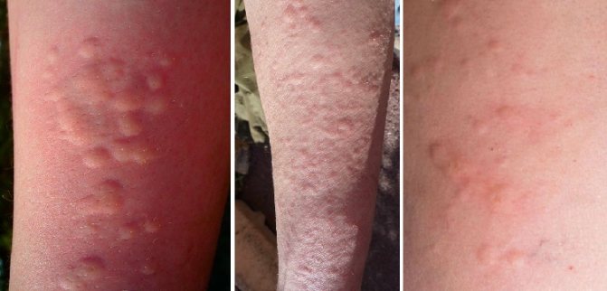 A rash has gone itching all over the body