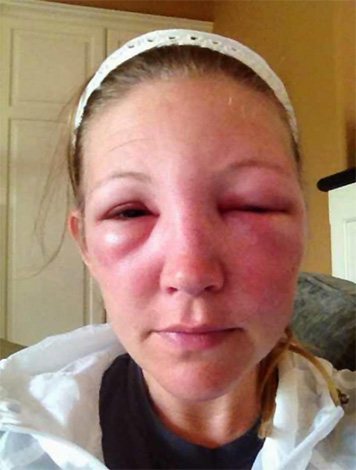 After a Japanese hornet bite, a powerful allergic reaction can develop, accompanied by severe tissue edema.
