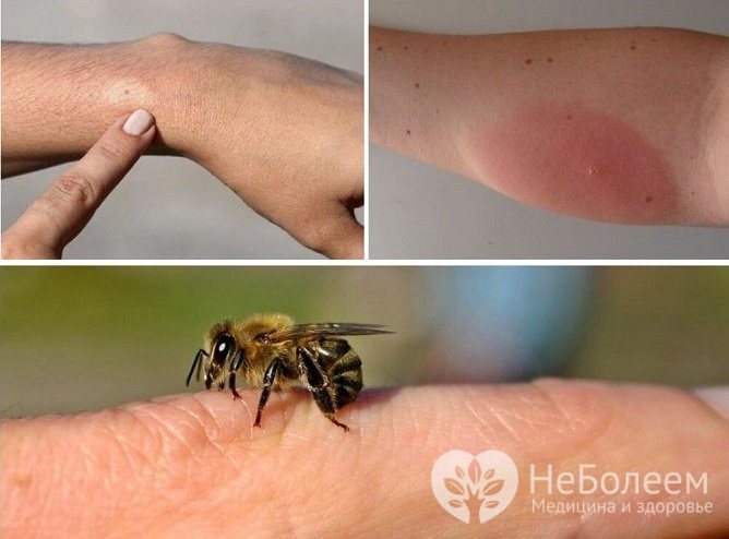 The appearance of a large edema after a bee sting indicates the development of an allergic reaction