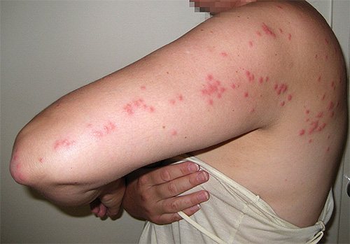 With bedbug bites, you should not self-medicate and use tansy uncontrollably, which is a rather poisonous medicinal plant.