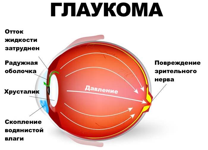 Признаци на глаукома