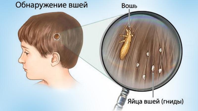 Prävention von Kopfläusen bei Kindern in der Schule