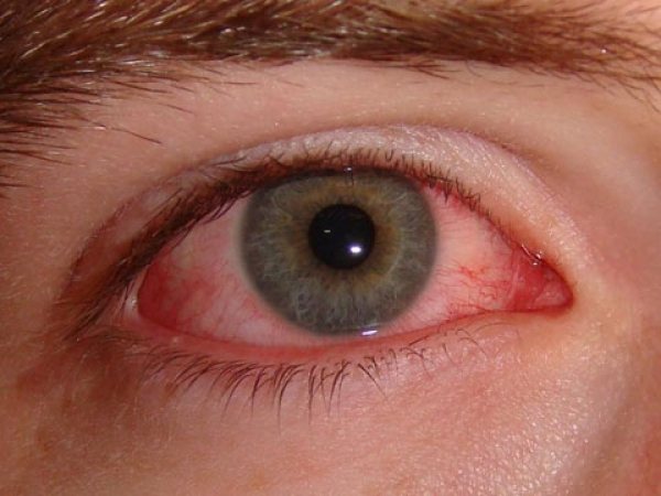 Acarianul de praf: foto a parazitului, semne ale reacțiilor alergice și tratamentul acestora