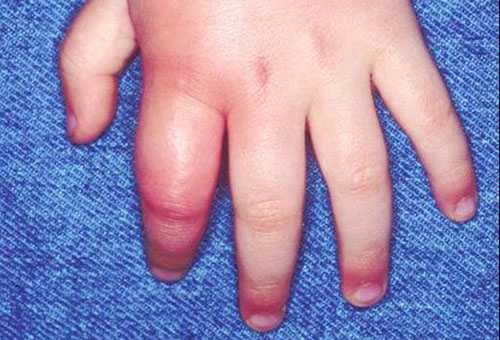 Mâna copilului după o mușcătură de viespe