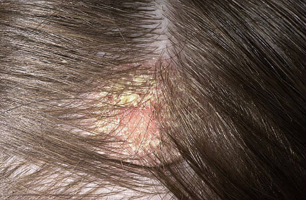 التهاب الجلد الدهني في الشعر