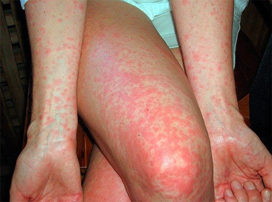 Těžká alergická vyrážka způsobená kousnutím ploštice