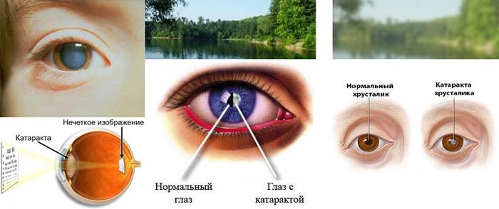 Симптоми на катаракта