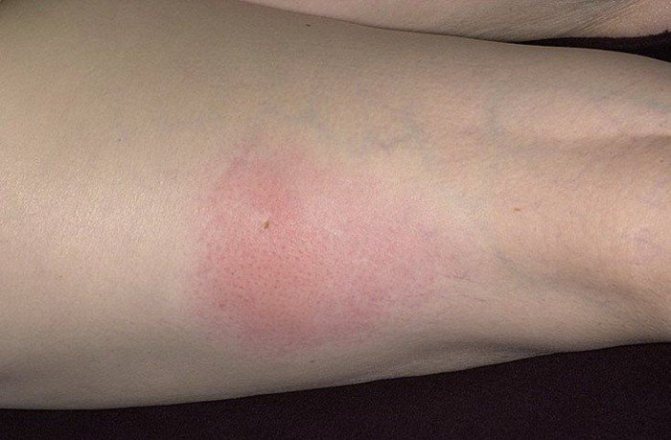 Relieve swelling after an insect bite