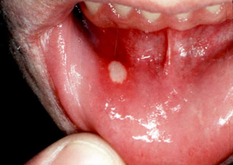 يمكن أيضًا علاج التهاب الفم بأدوية دوشيني.