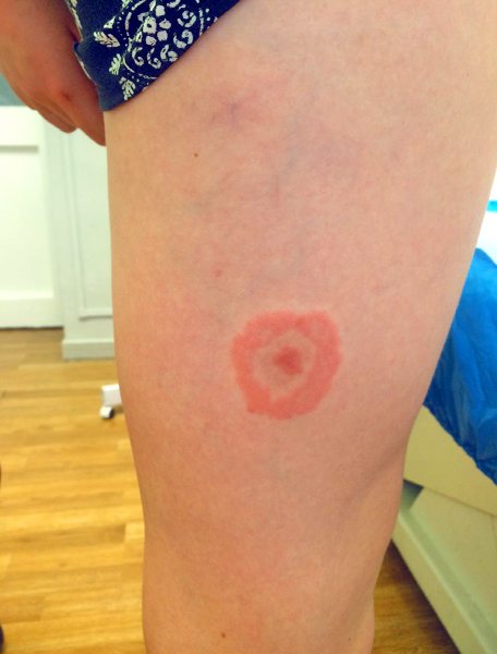 Typical erythema migrans at the site of the bite, which can appear even several weeks after the parasite is sucked in.