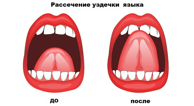 Shortened frenum of the tongue